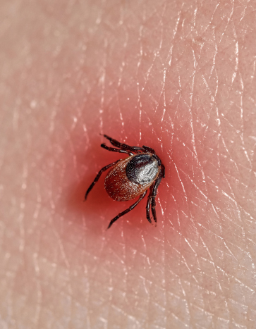 Tick biting down on human skin – Tick Pest Control Tick biting down on human skin - Tick Pest Control